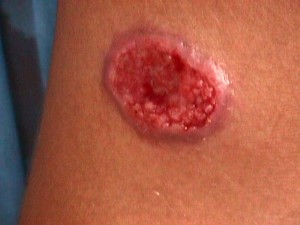 Confirmed case of leishmaniasis (© www.dragonfly75.com)