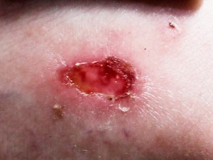 My wound: Leishmaniasis or not?