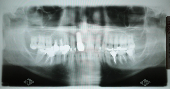 X-ray of my teeth. Puzzle Picture: Find the healthy tooth!